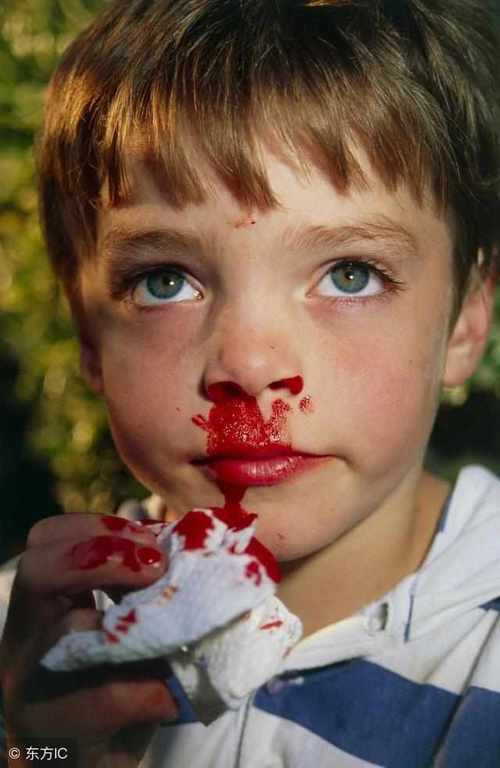 小孩流鼻血的相关图片