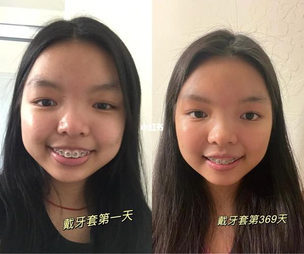 戴牙套一年脸型的变化的相关图片