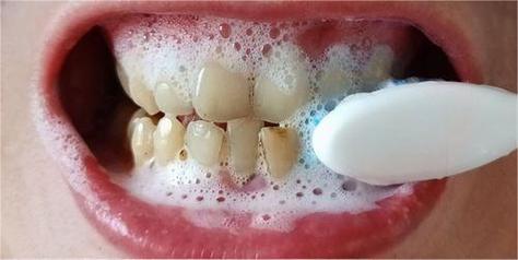 牙齿怎么才可以变白的相关图片